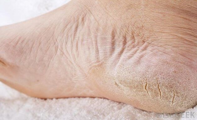 Trockene Füße sind ein Zeichen für Pilzbefall