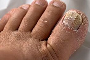 Foto von Nagelpilz