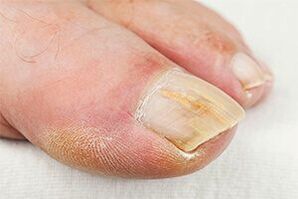Masse -Finger