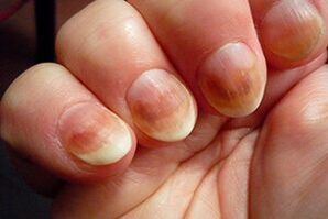 Nagelpilz