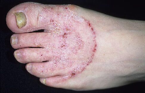 Füße und Nagelpilz