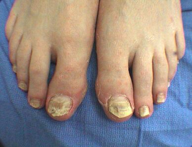 Symptome von Nagelpilz