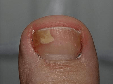 Pilz auf der linken Seite des Nagels