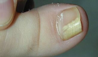Anzeichen und Symptome von Nagelpilz