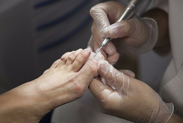 Diagnose des Pilzes der Beine
