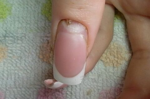Symptome von Nagelpilz